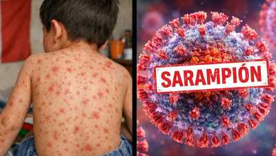 Sanidad notifica en Tenerife un brote de sarampión con cuatro casos confirmados