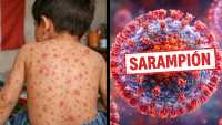 Sanidad notifica en Tenerife un brote de sarampión con cuatro casos confirmados