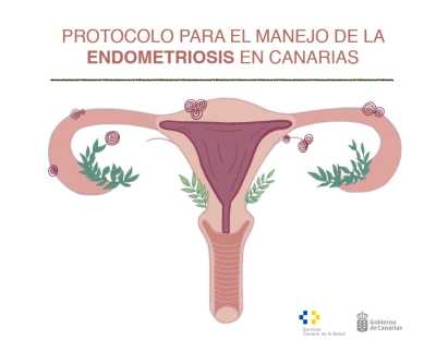 Sanidad registra a más de 12.000 mujeres diagnosticadas de endometriosis en Canarias